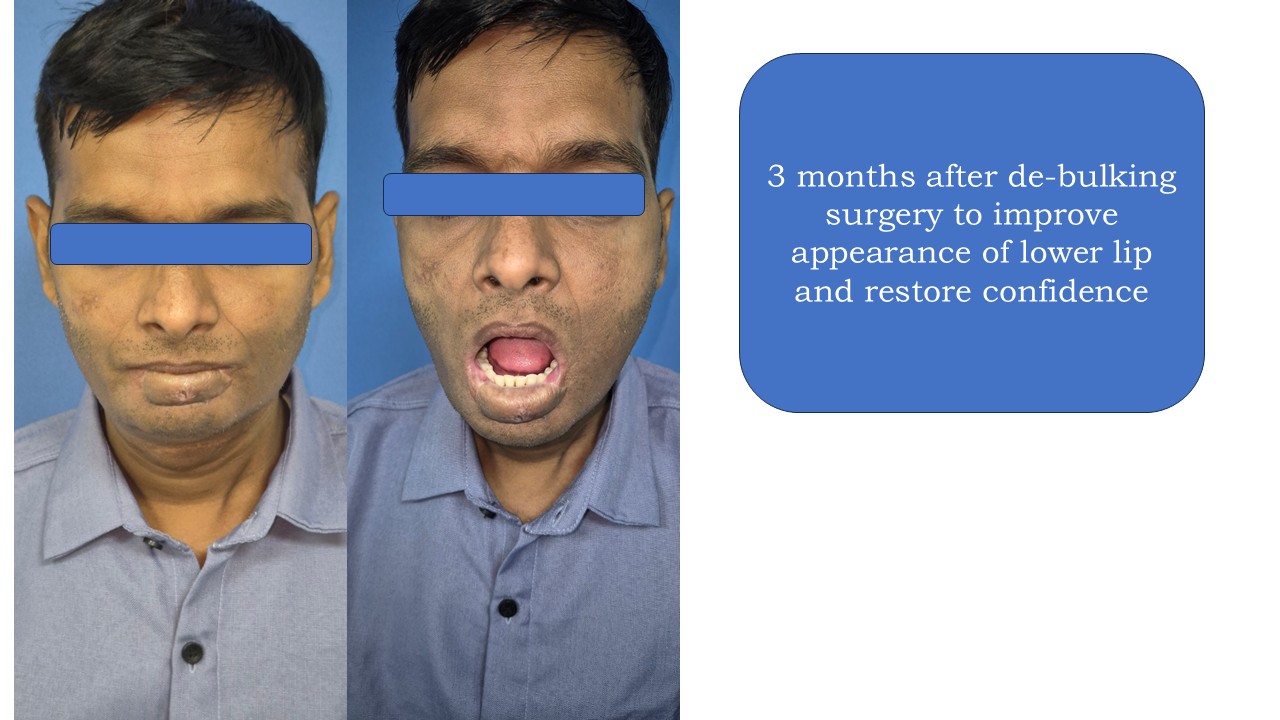 Cancer Reconstruction Photo 7