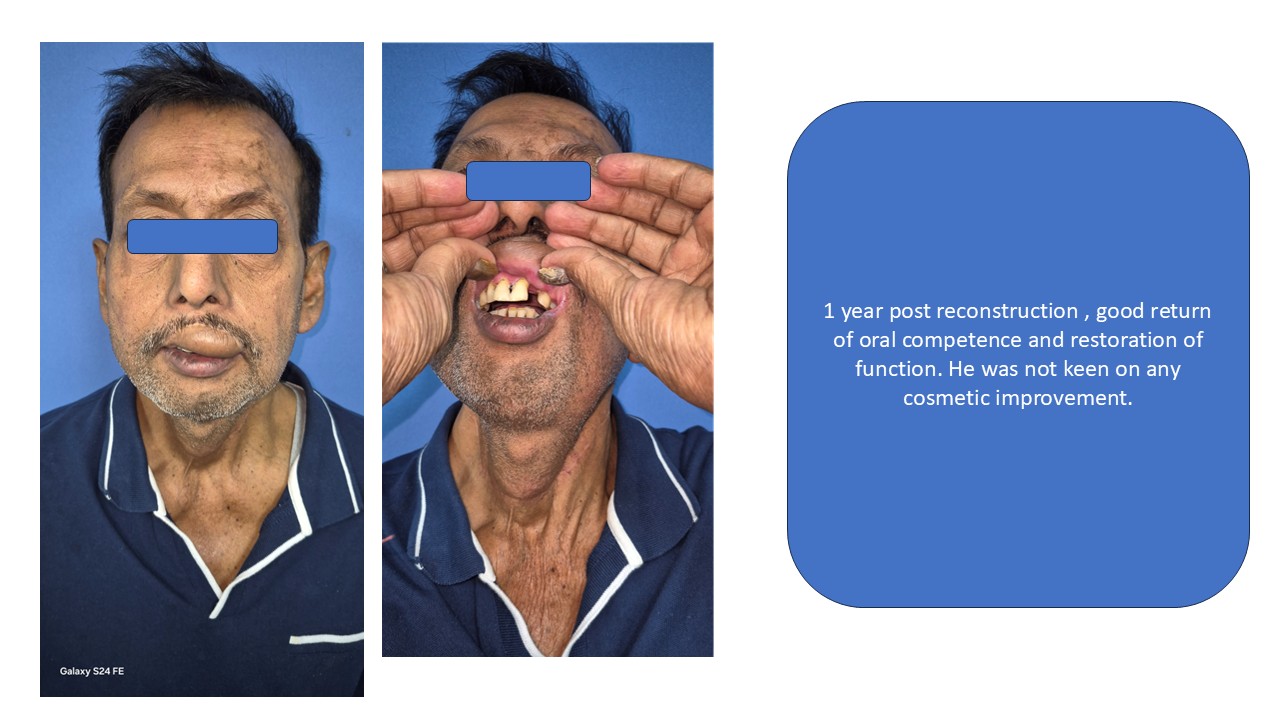 Cancer Reconstruction Photo 9