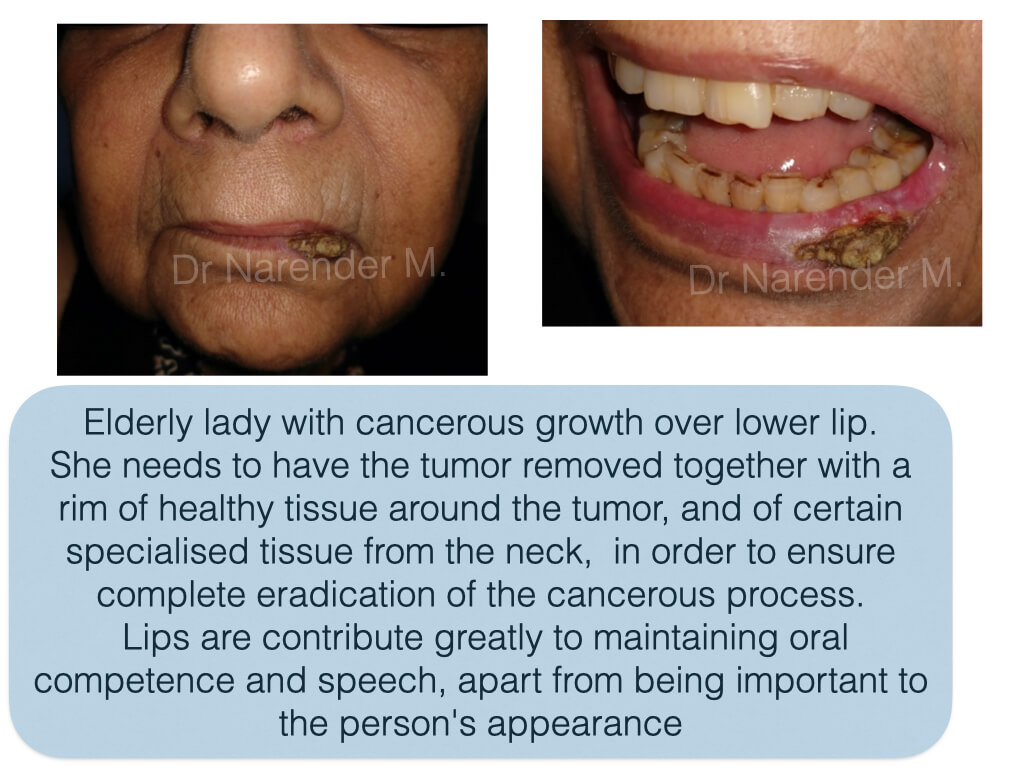 Cancer Reconstruction Surgery