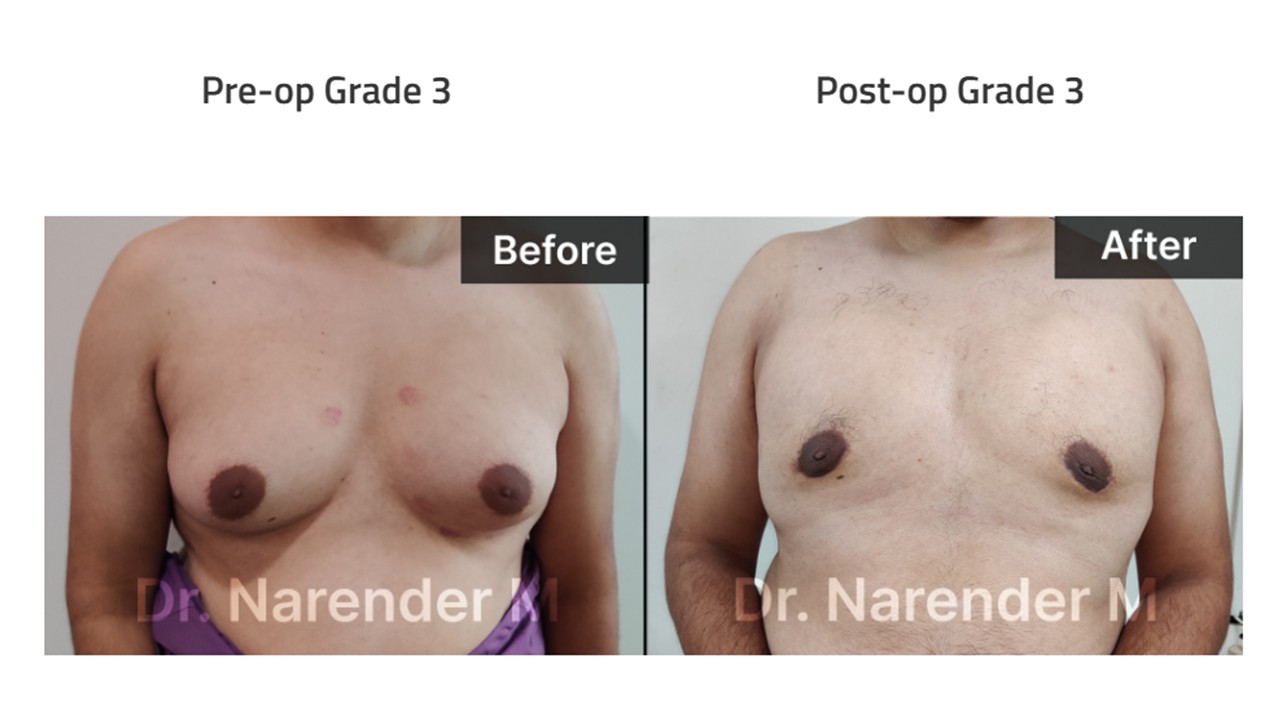 Gynecomastia Photo 1