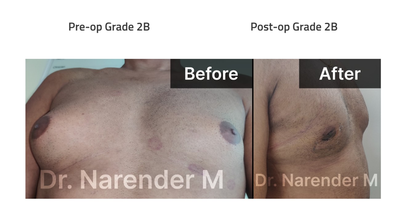Gynecomastia Photo 10