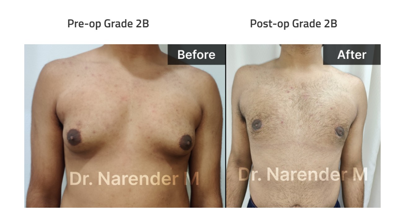Gynecomastia Photo 11