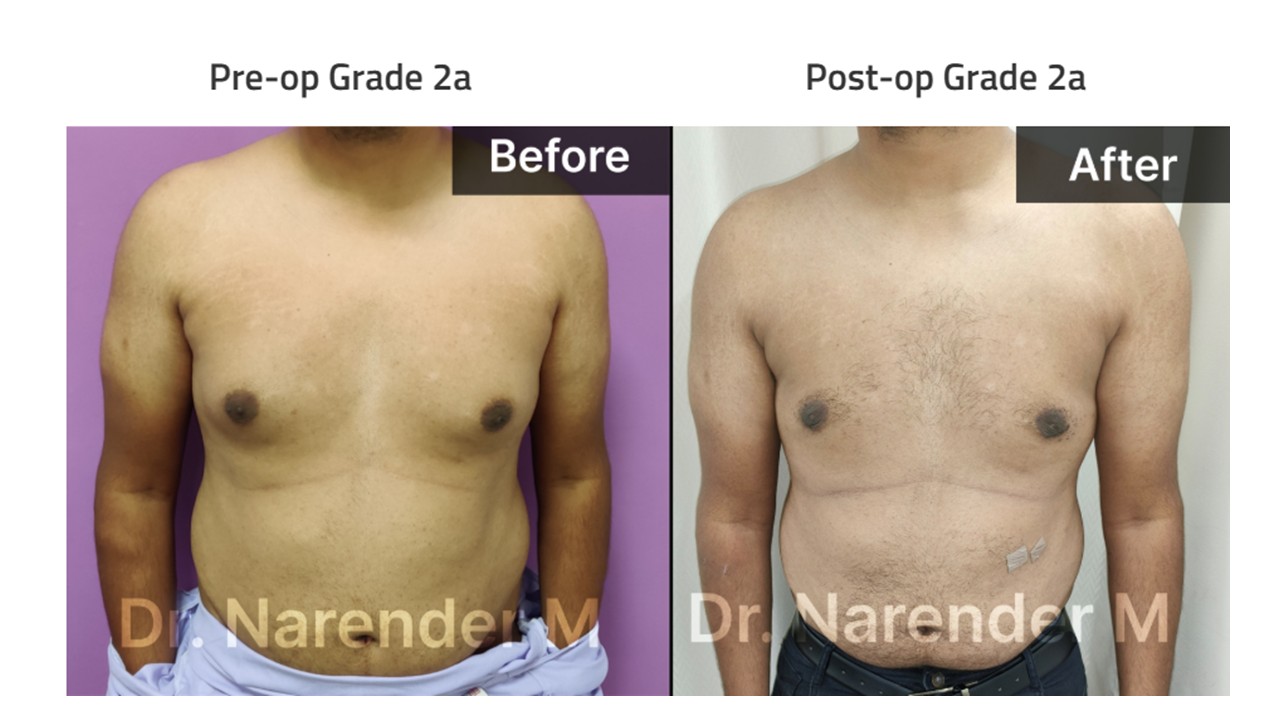 Gynecomastia Photo 12