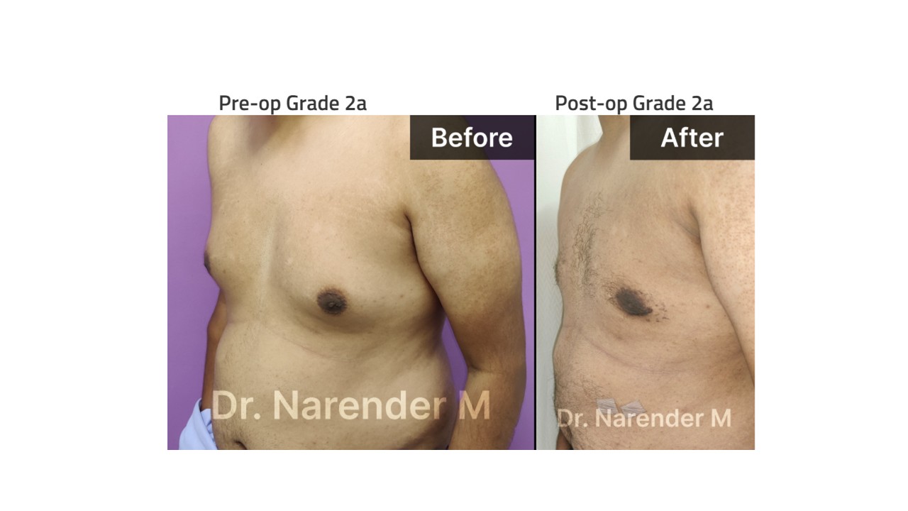 Gynecomastia Photo 13