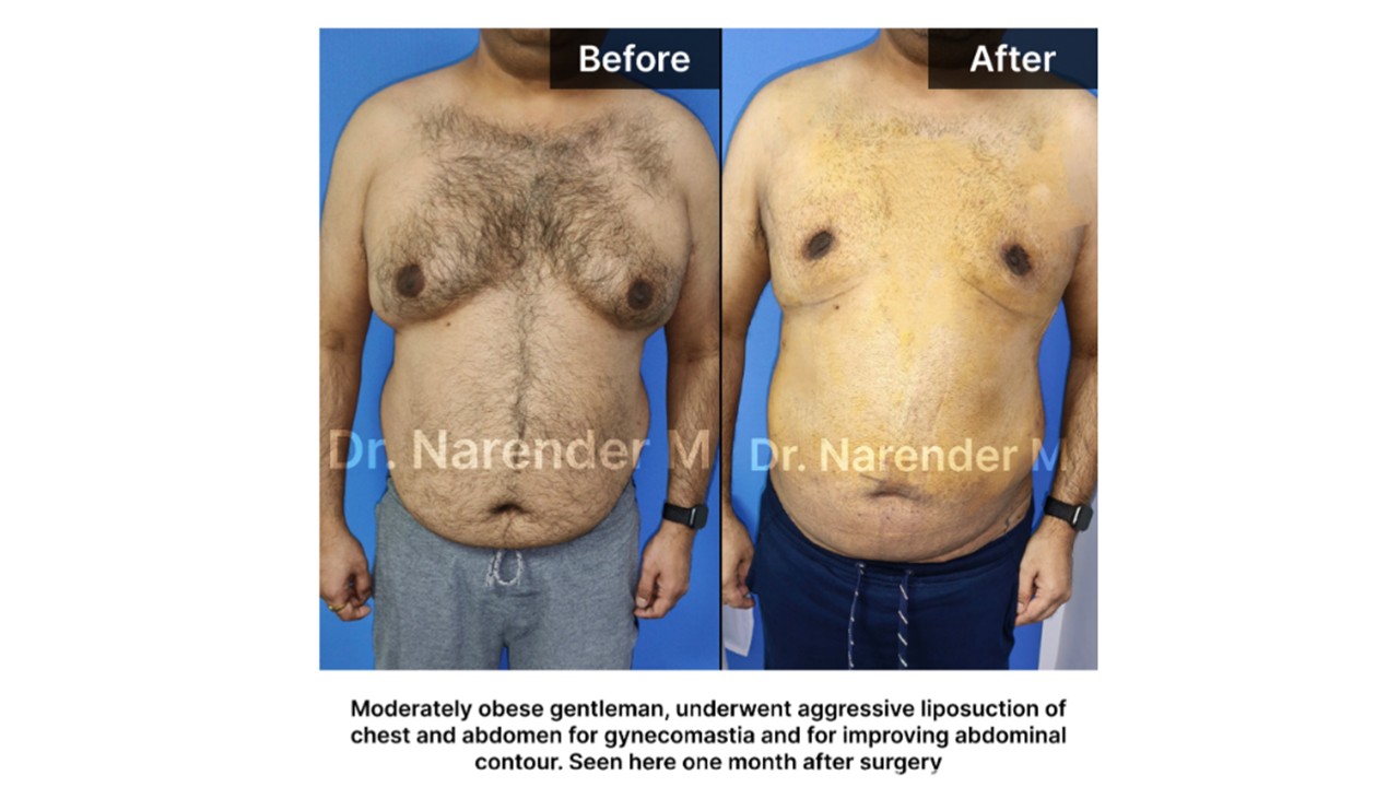 Gynecomastia Photo 14