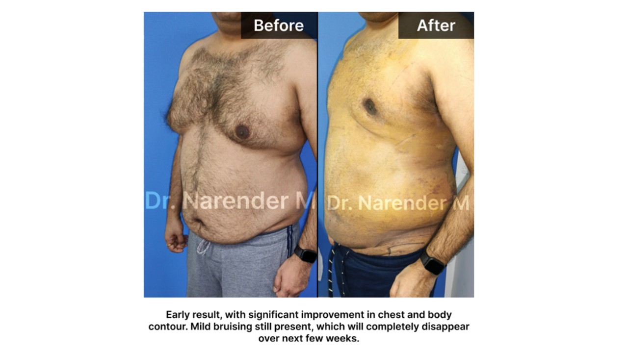 Gynecomastia Photo 15