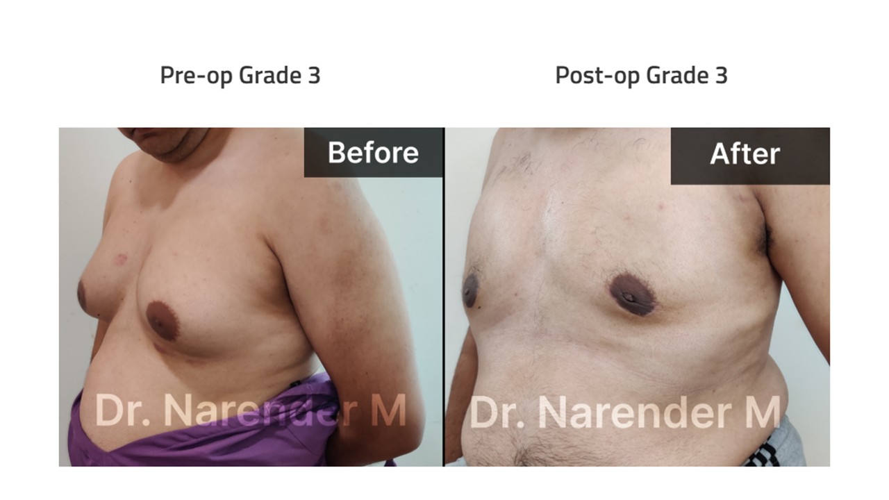 Gynecomastia Photo 2
