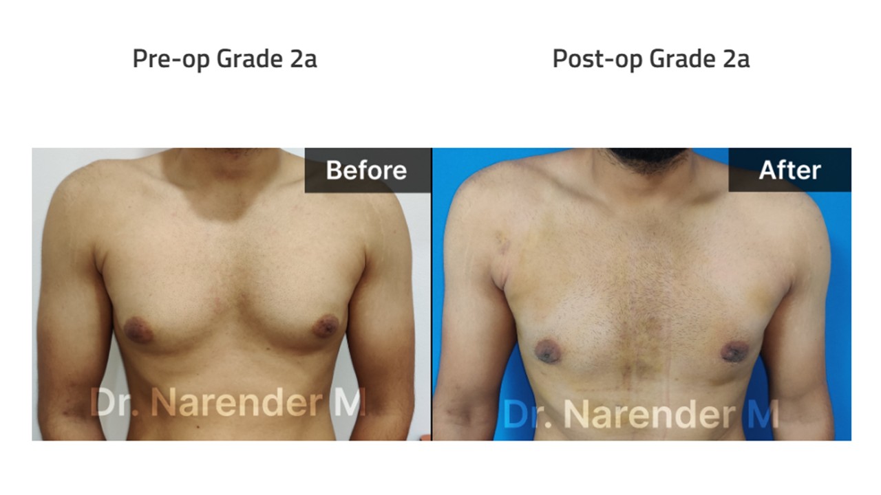 Gynecomastia Photo 3