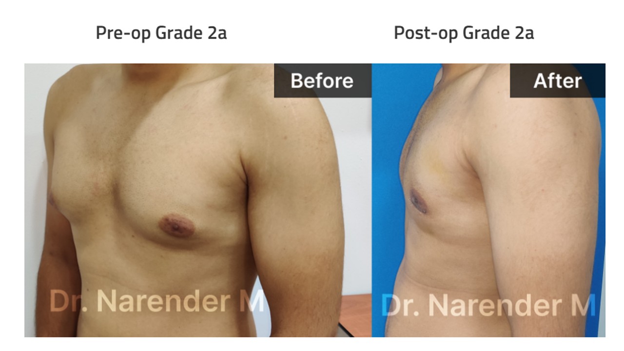 Gynecomastia Photo 4