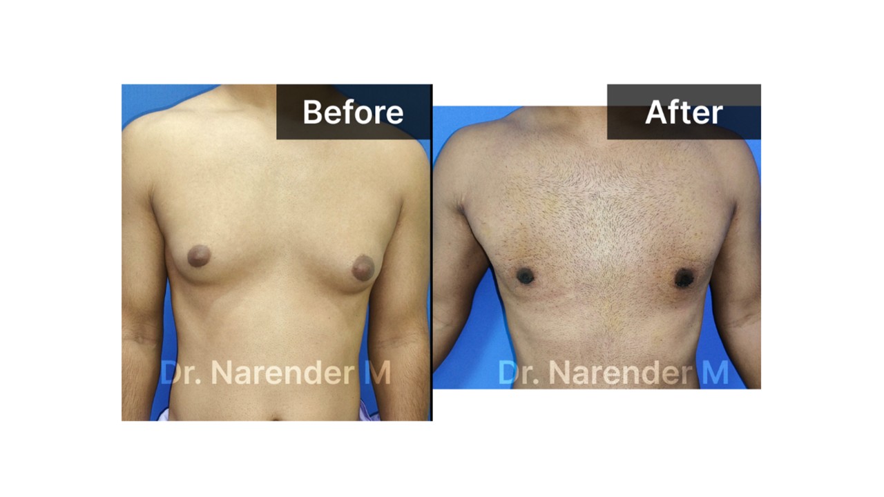 Gynecomastia Photo 5