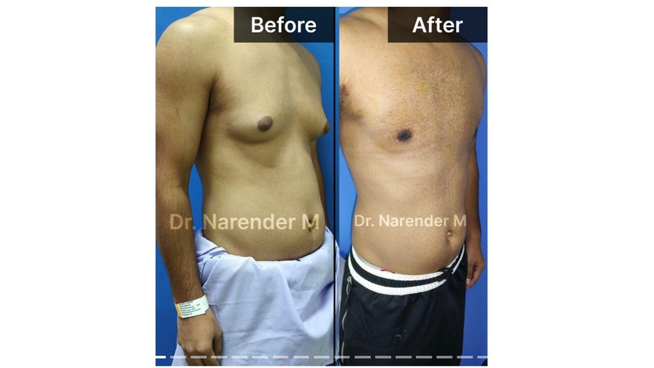 Gynecomastia Photo 6