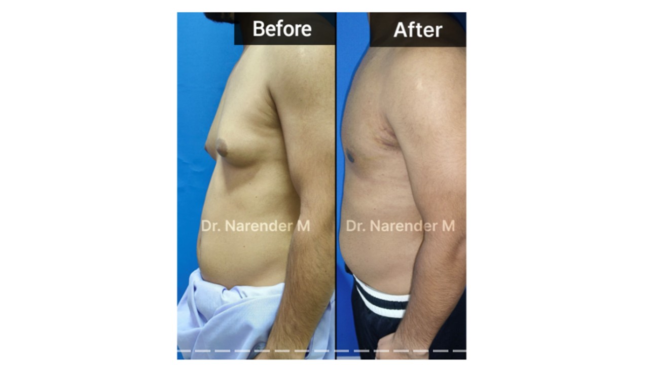 Gynecomastia Photo 7