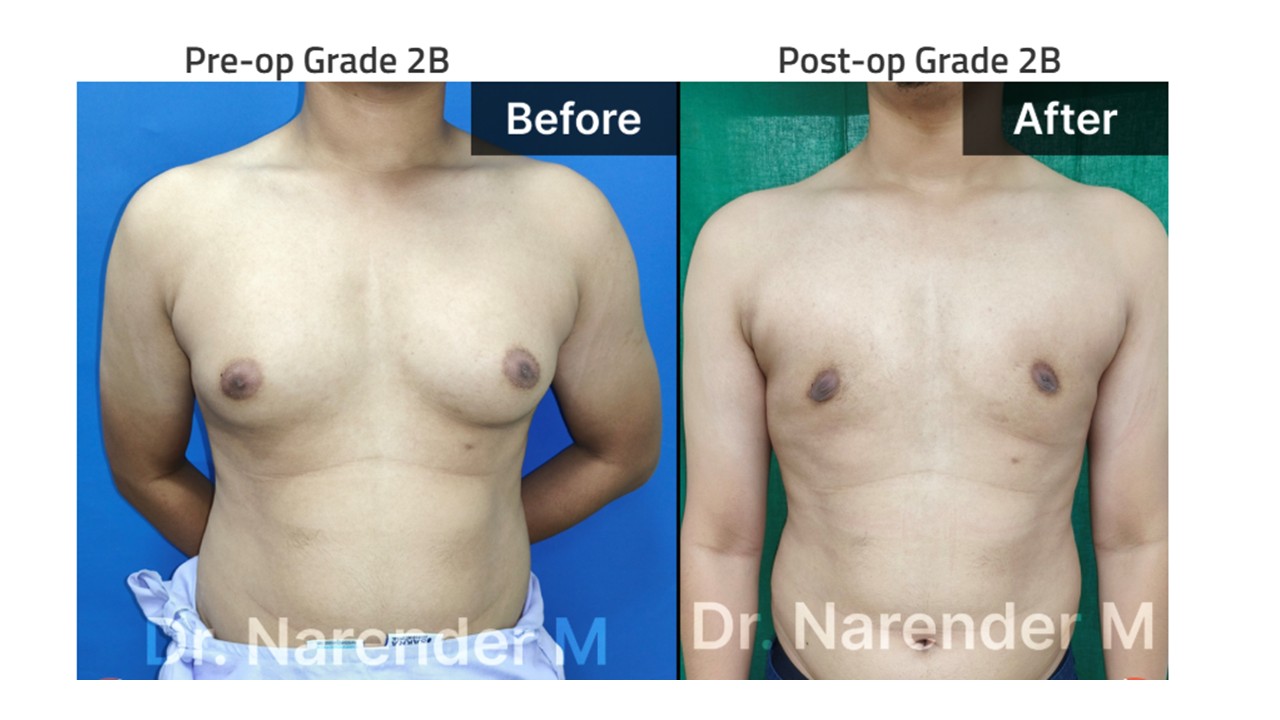 Gynecomastia Photo 8