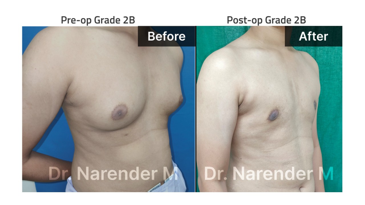 Gynecomastia Photo 9