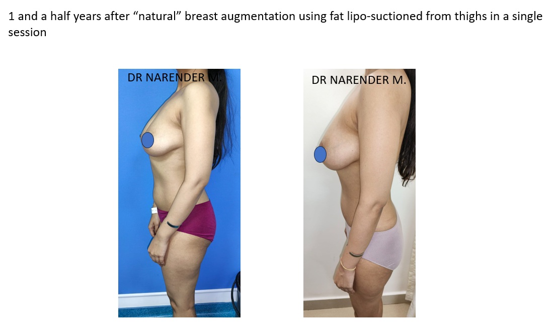 Breast Augmentation Surgery