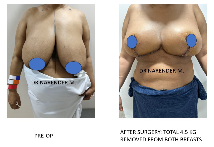 Breast Lift Surgery