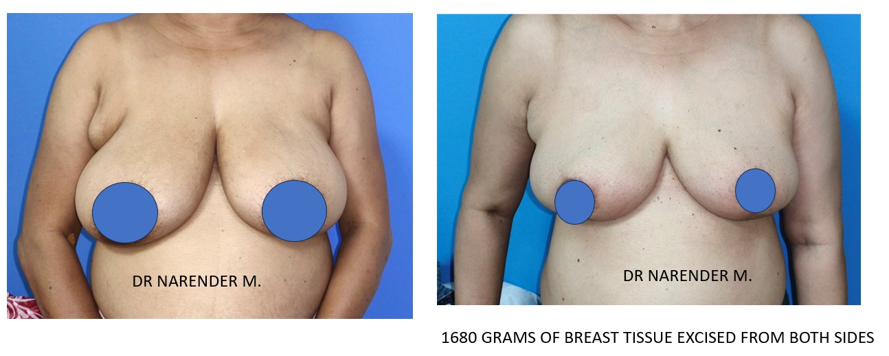Breast Reconstruction Surgery
