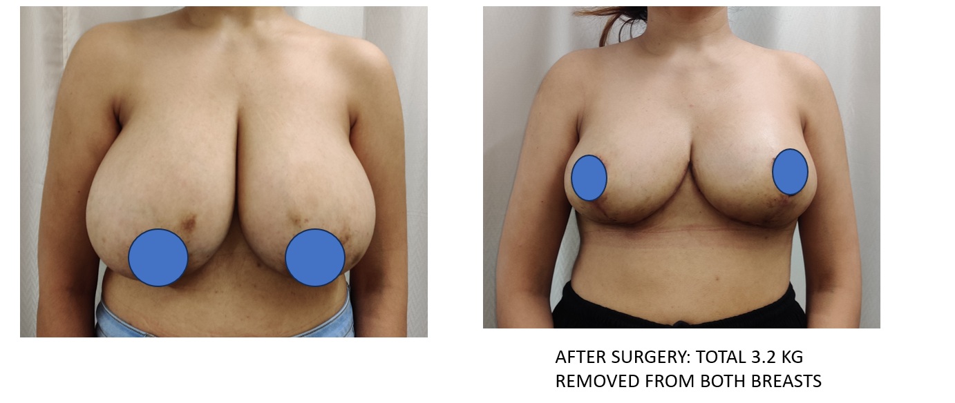 Breast Reduction Surgery