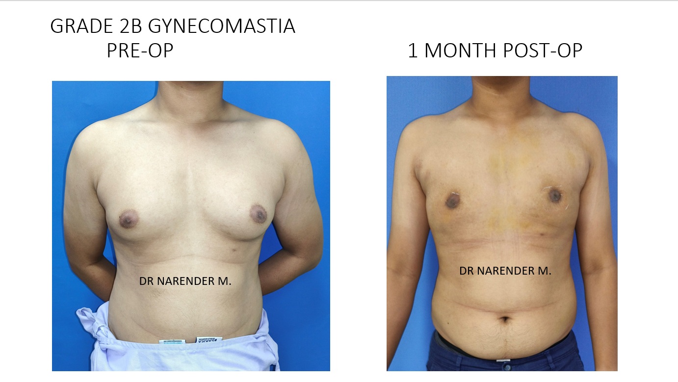 Gynecomastia Surgery