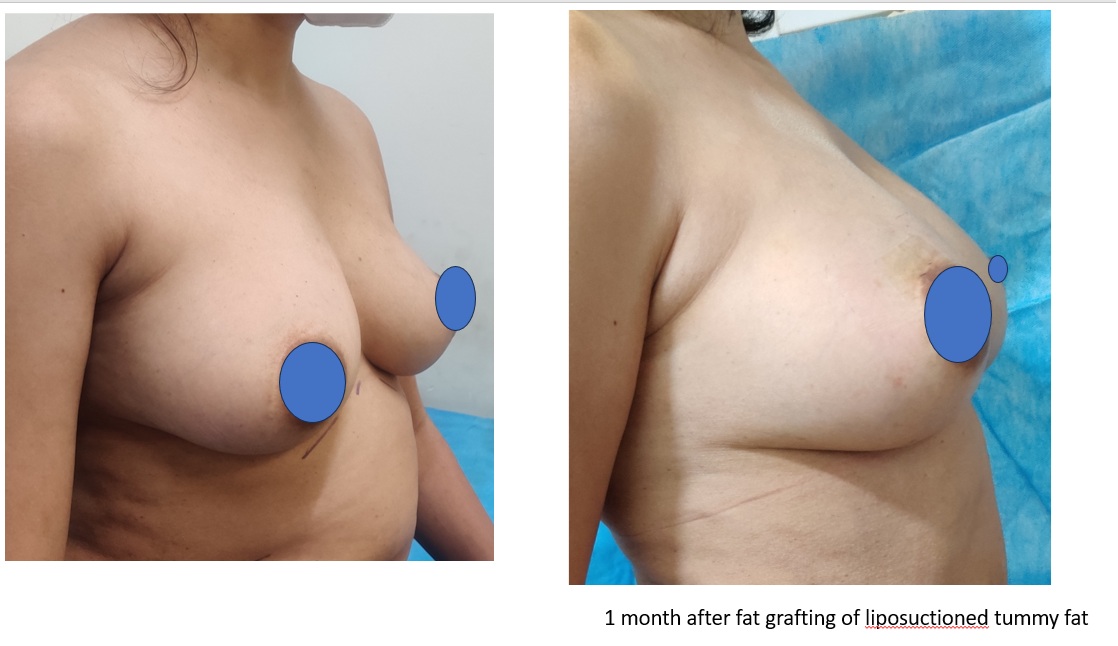 Liposuction Surgery