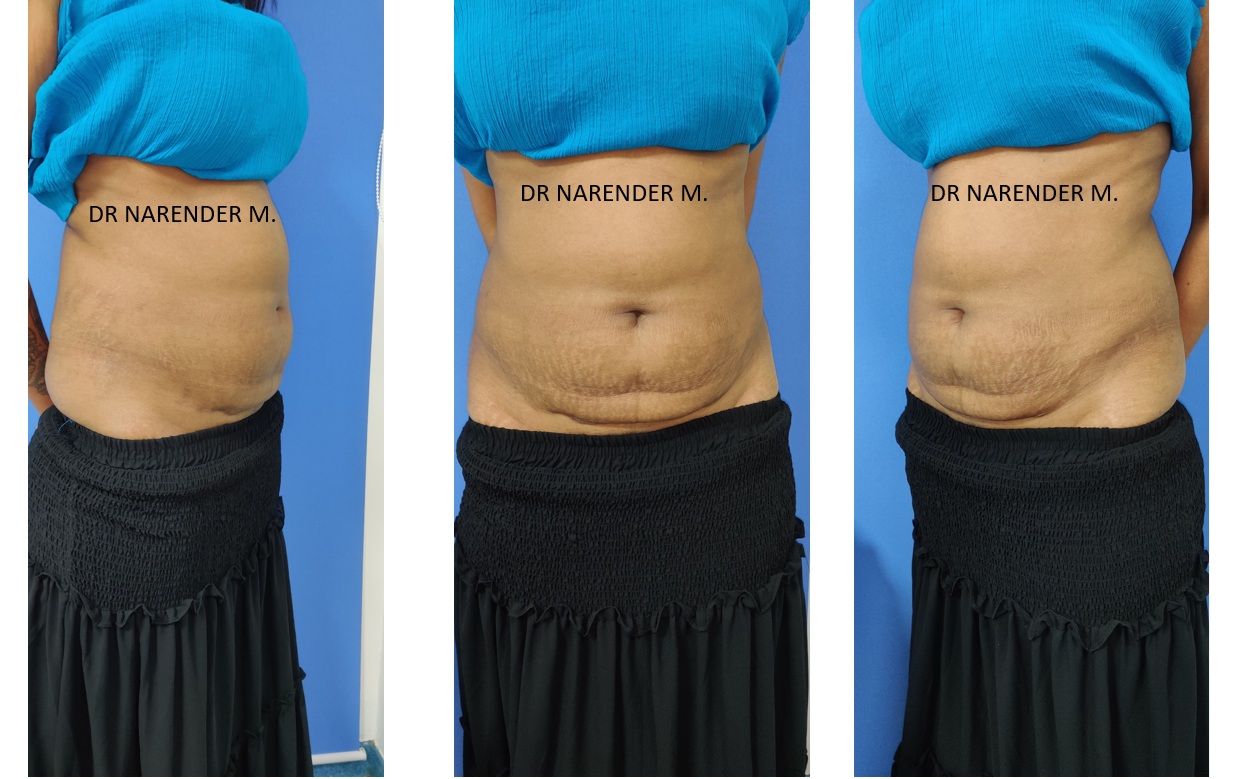 Tummy Tuck Surgery