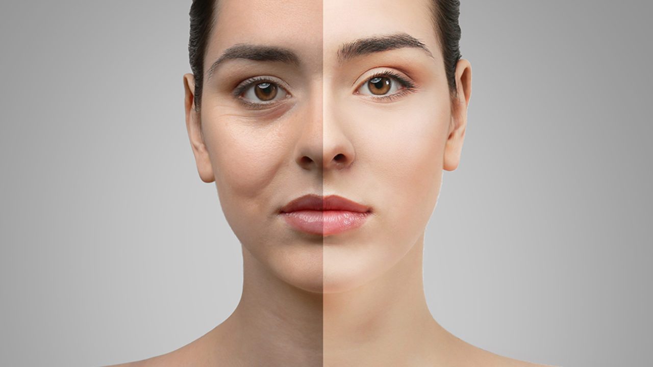 Blepharoplasty Treatment