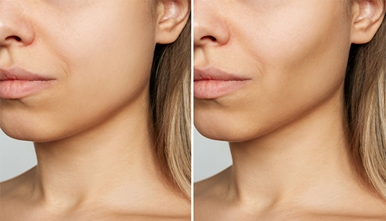 Buccal Fat Pad Removal