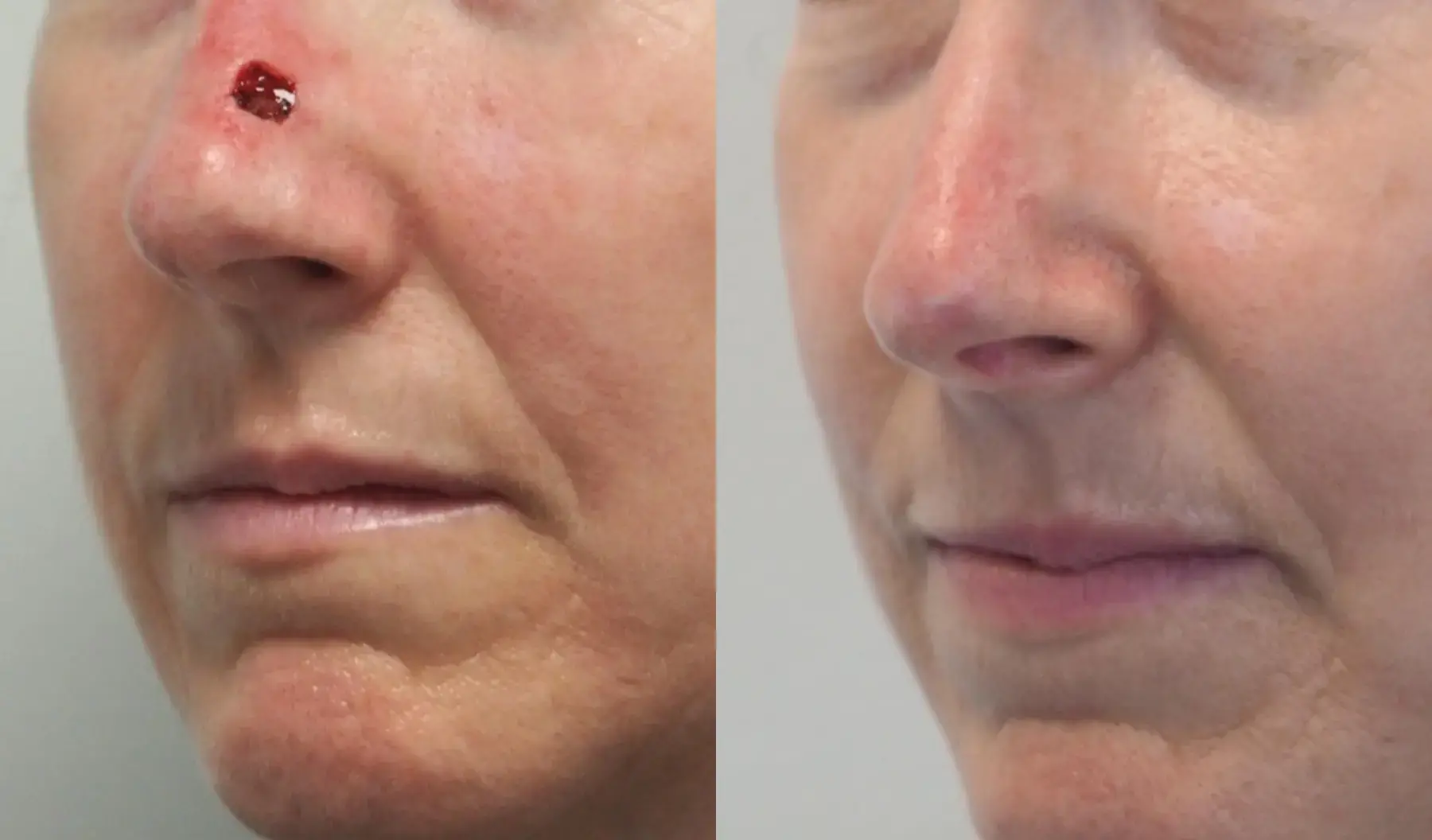 Cancer Reconstruction