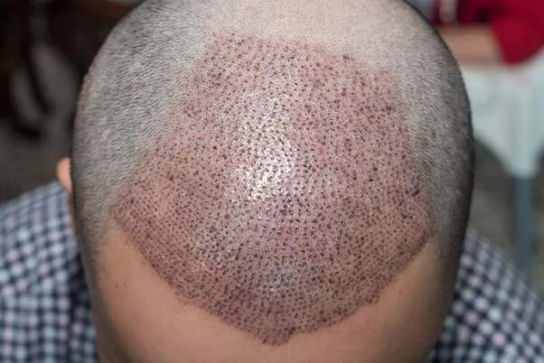 Hair Transplantation