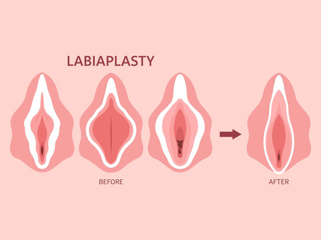 Labiaplasty Surgery